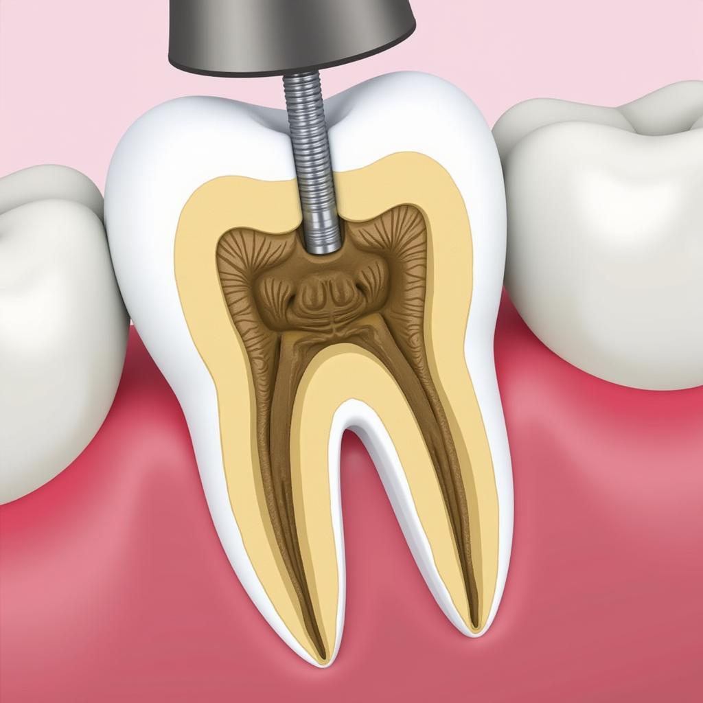 Gutta-Percha Root Canal Filling