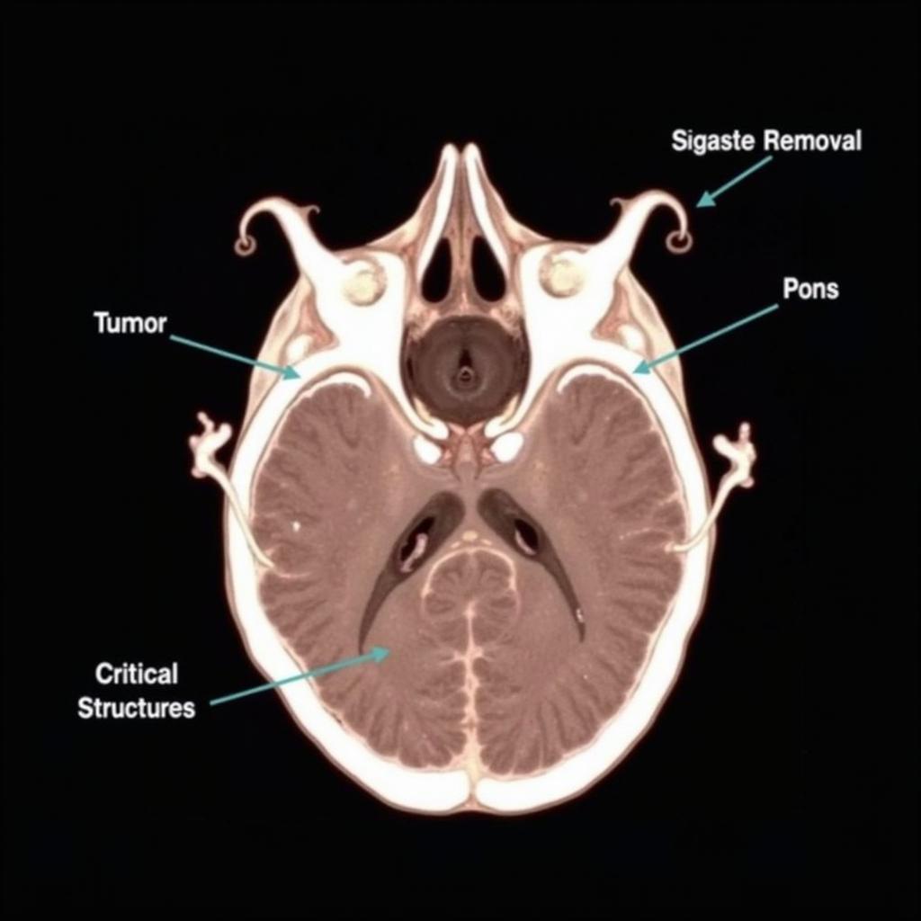 DIPG Location in Brainstem